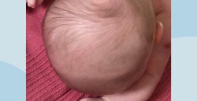 Plagiocefalia nei neonati: Genitori cosa dovete sapere